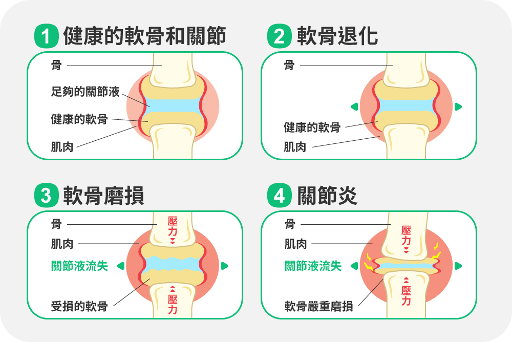 關節退化的四大階段